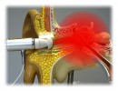 TINNImed 2 Therapie-Laser mit 1 Ohrteil